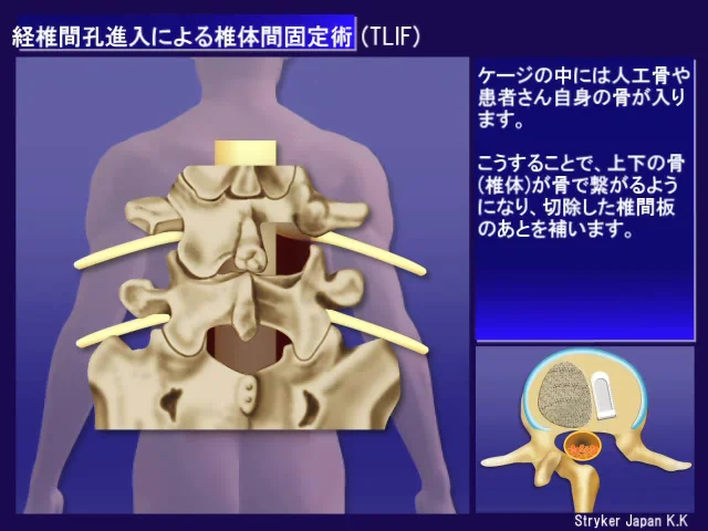 椎体間固定術(ついたいかんこていじゅつ)|脊椎手術.com 椎体間固定術(ついたいかんこていじゅつ)|脊椎手術.com