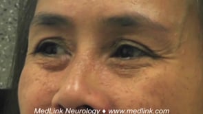Spinocerebellar ataxia type 2