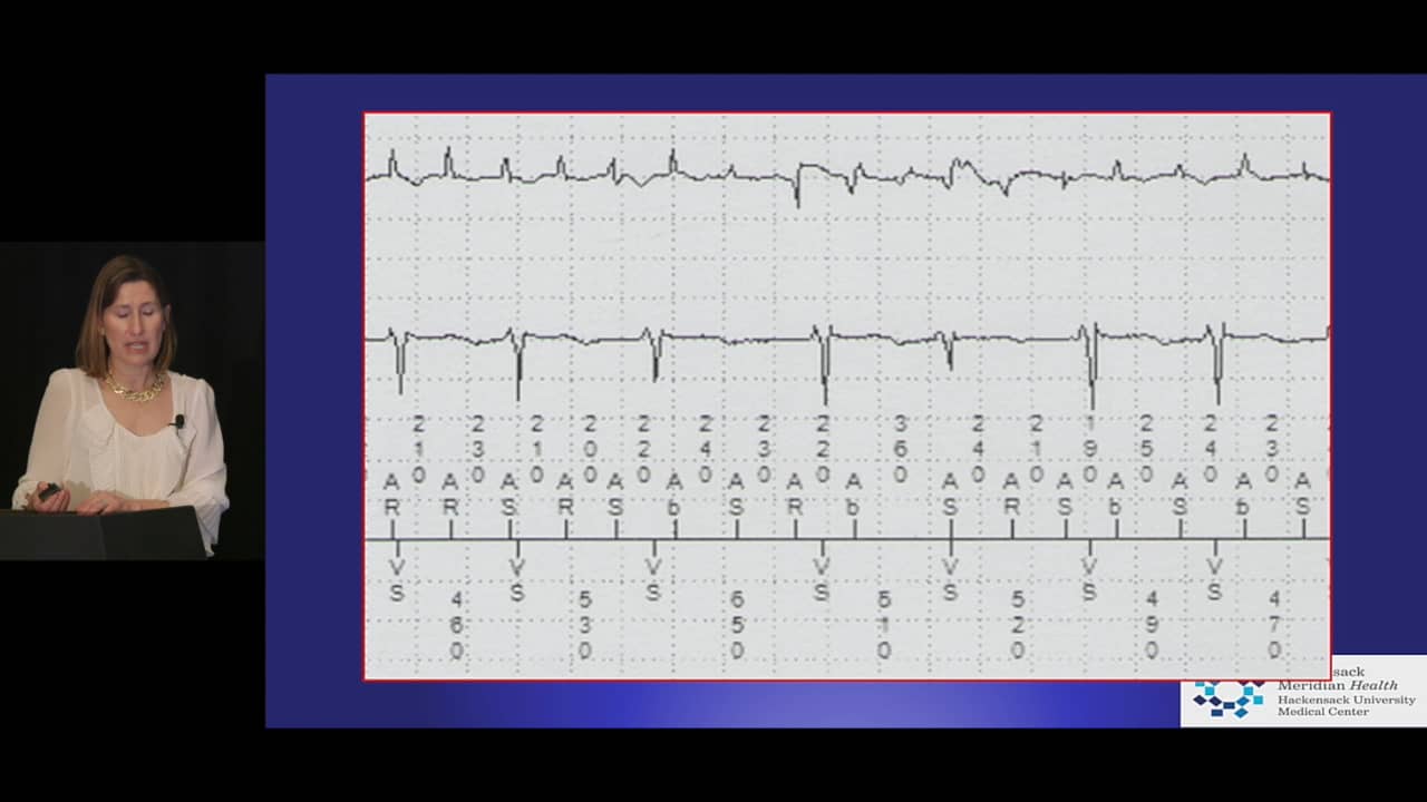 Spaf Acc2019 - Subclinical Af Incidence And Management-taya Glotzer On 