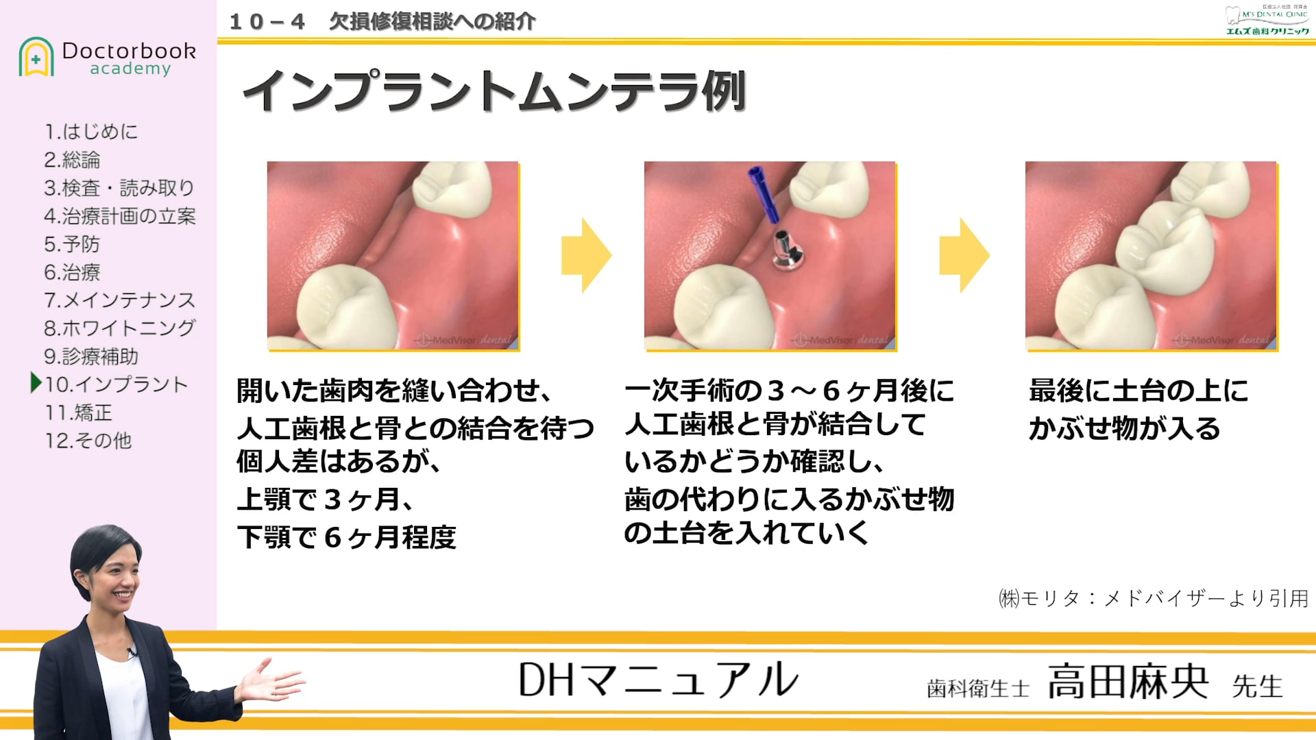 第10章 インプラント