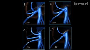 Exerese Totale Du Mesocolon Etmc Par Voie D Abord Laparoscopique Pour Cancer Du Colon Droit Websurg The Online University Of Ircad