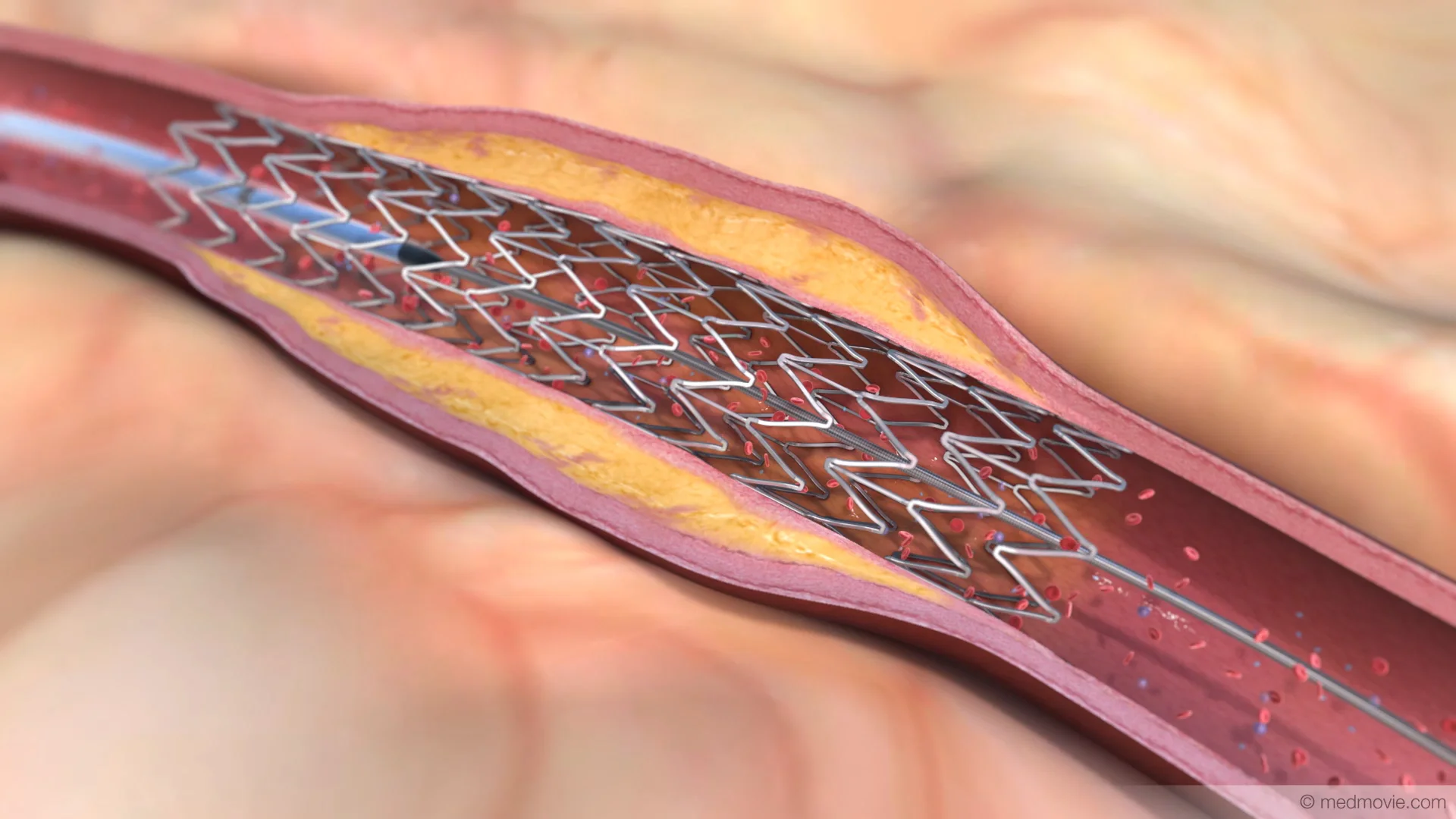 Angiogram Animation on Vimeo
