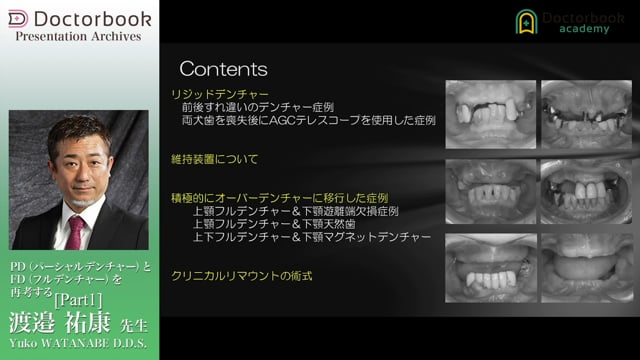 PD（パーシャルデンチャー）とFD（フルデンチャー）を再考する