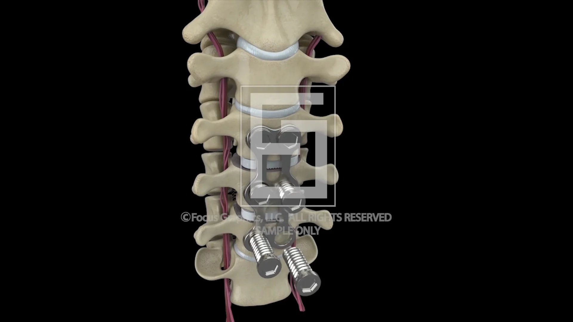 Focus Graphics C5 C7 Cervical Fusion Sample On Vimeo