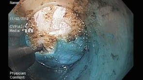 Peroral Endoscopic Myotomy (POEM)