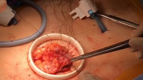 Laparoscopic Left Colectomy