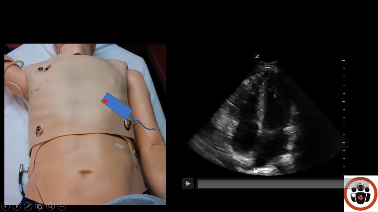 POCUS Cases 3: LV Systolic Dysfunction 