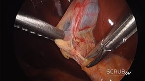 Laparoscopic Cholecystectomy