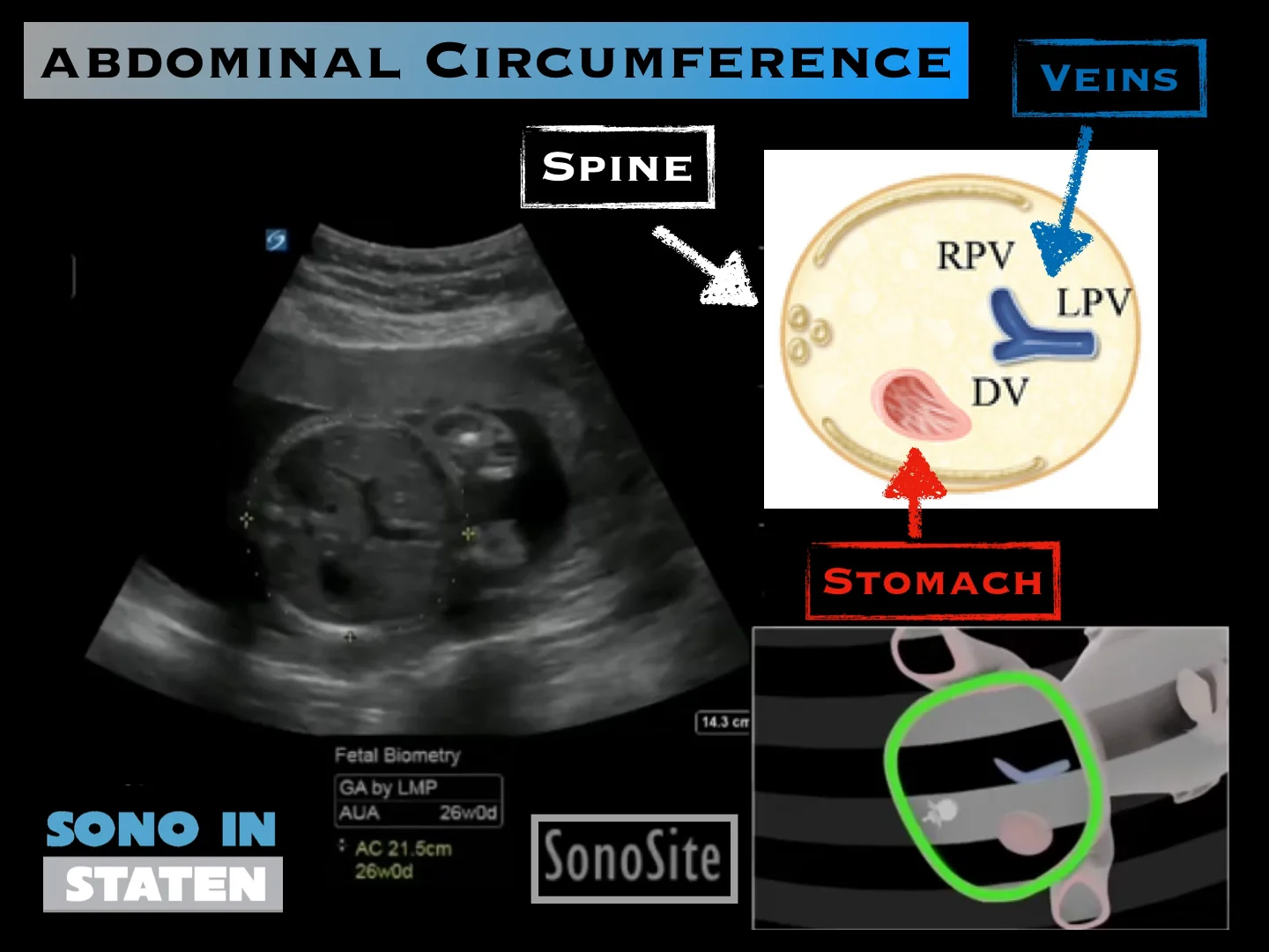 人気ブランドランキング - Circumference Abdominal Fetal SIUH — Measurements 臨床医学