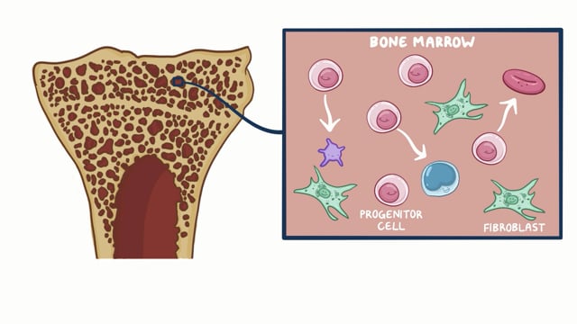 Rare Disease Video - Myelofibrosis - National Organization for Rare  Disorders