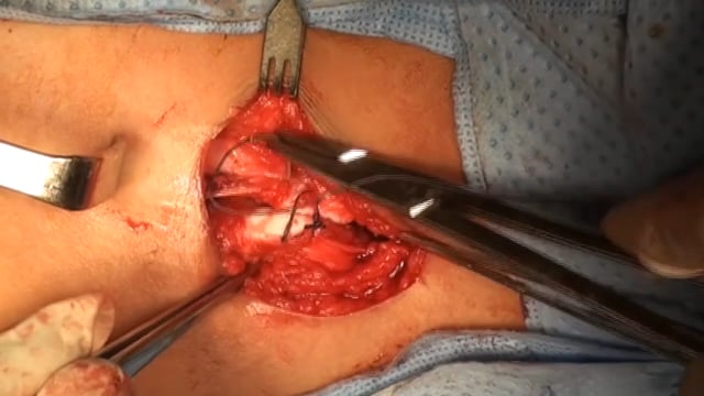 Iliac Open Reduction and Osteotomy