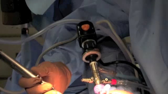 Arthroscopic Distal Clavicle Resection