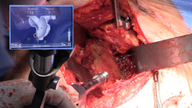 Computer Assisted Reverse Shoulder Arthroplasty and Glenoid Bone Grafting for Severe Glenoid Retroversion