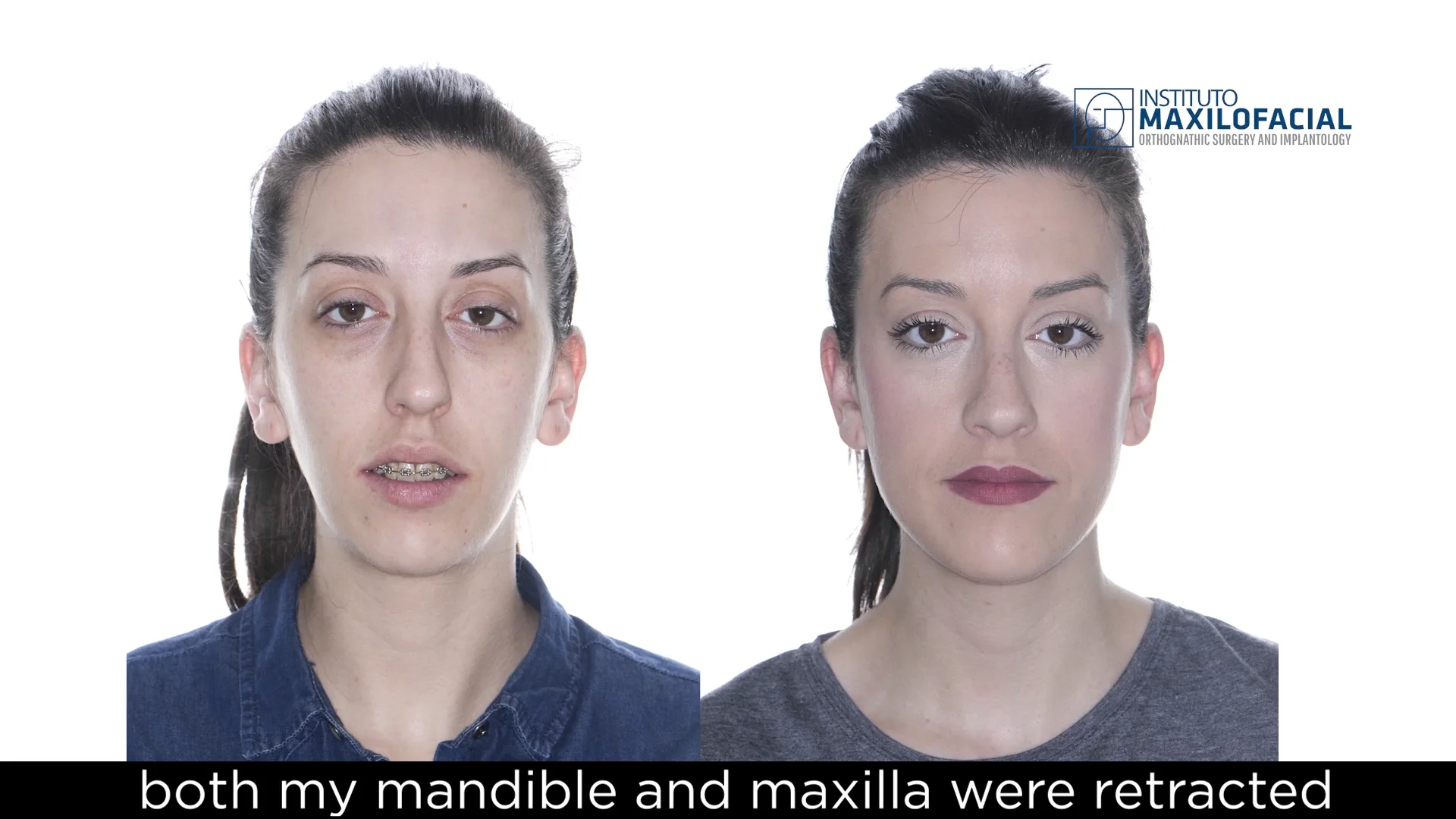 Why is one side of my face more swollen than the other after my  orthognathic surgery? - Instituto Maxilofacial