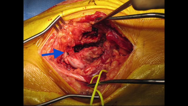 Repair of Displaced Partial Articular Fracture of the Distal Femur: The Hoffa Fracture