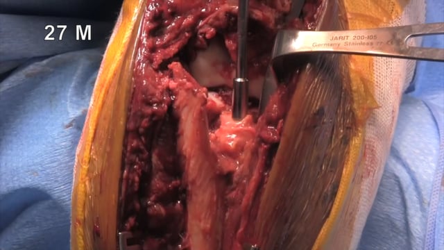 Repair of Bado II Monteggia Fracture