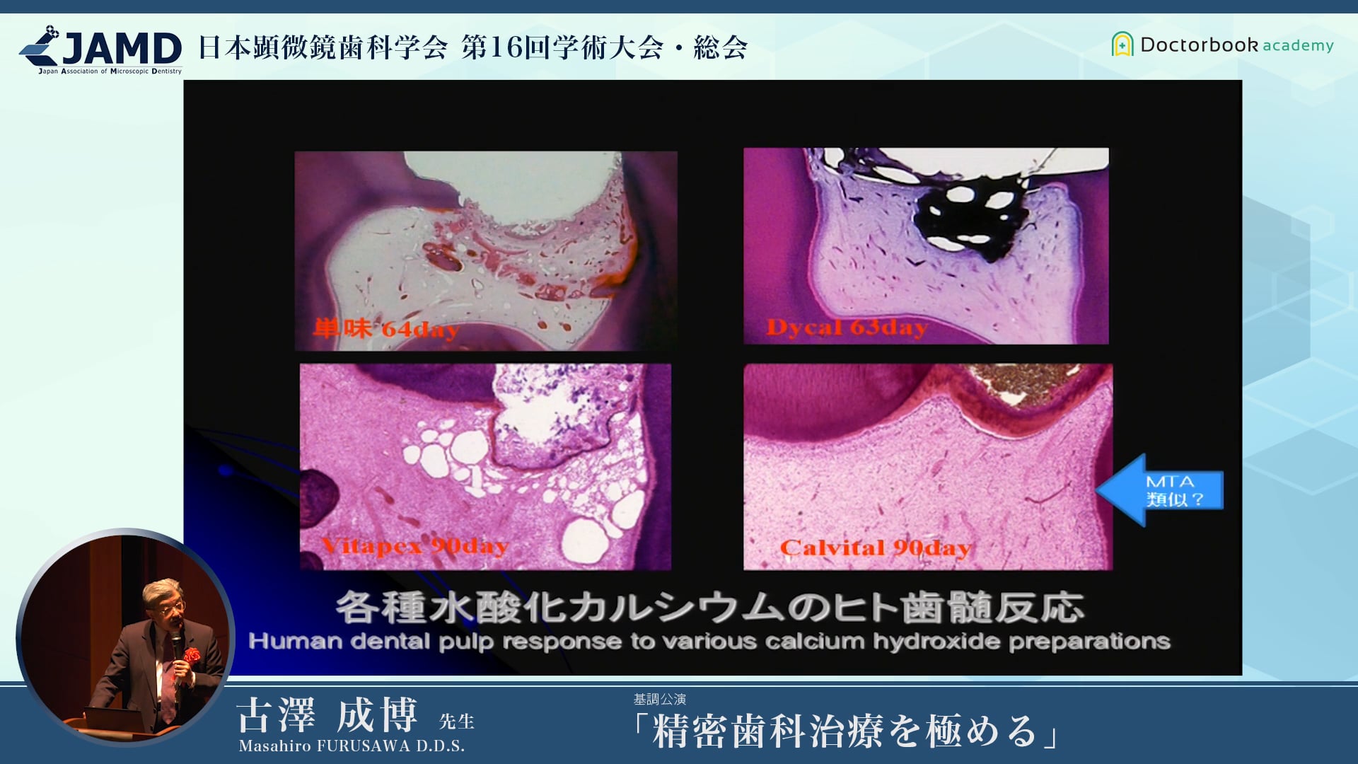 精密歯科治療を極める  #2  歯根端切除術