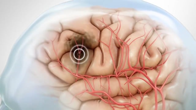 Cerebral Palsy Awareness - Video Thumbnail