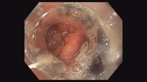 Over the Scope Clip (OTSC) Placement