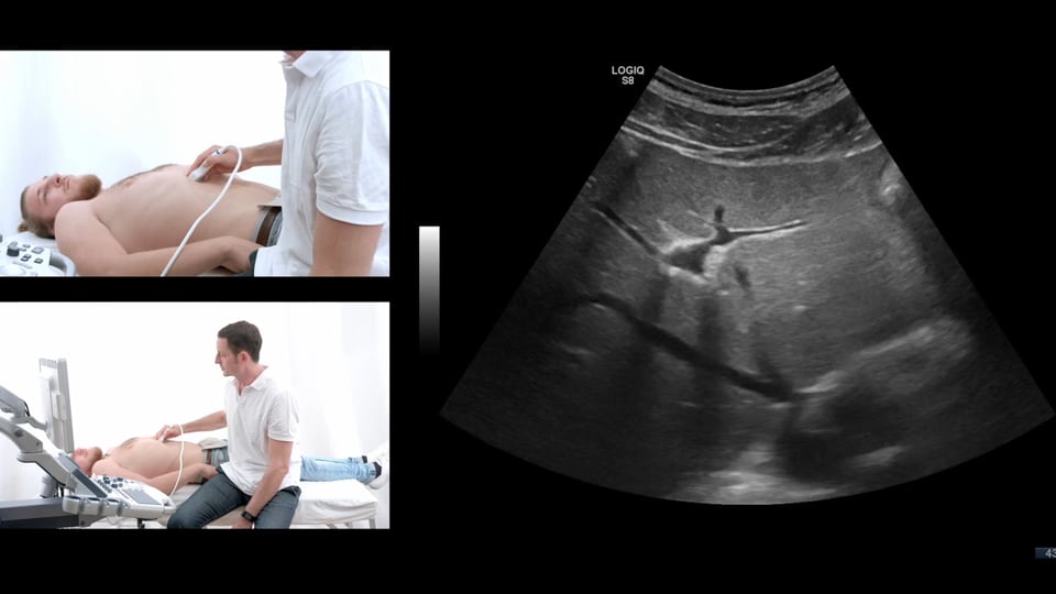 Liver Ultrasound