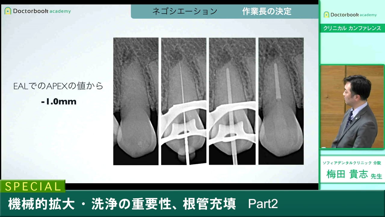 #2 根管形成