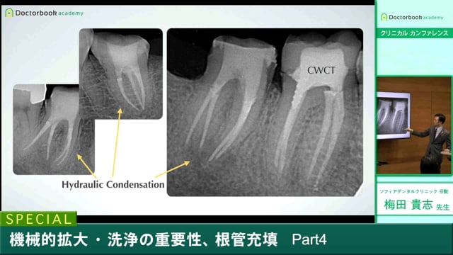 #4 根管充填の種類と予後