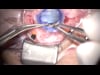 Trans- Opaque Corneal IOL Exchange Suture