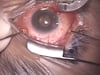 Bilat Endophthalmitis2 Stages 11 2 11
