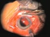 Post Trauma Pediatric IOL Suturing ca 2010
