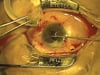 Pucker and Pupil Phimosis