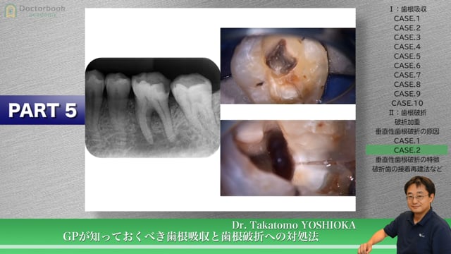 #5 垂直性歯根破折の原因