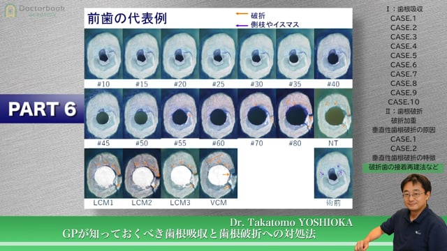 #6 破折歯の接着再建法