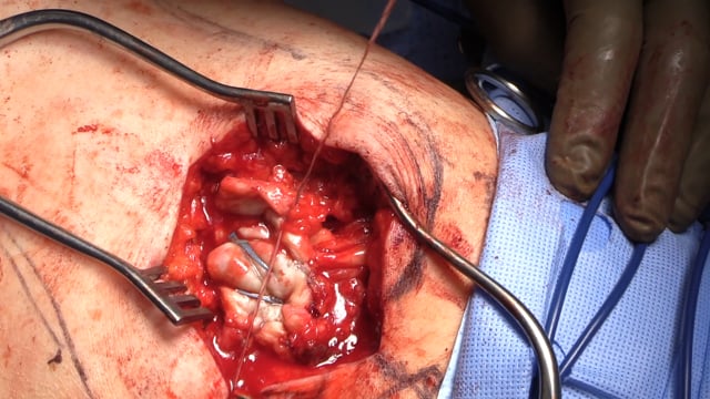 Reconstruction of a Chronic Abductor Tendon Tear Using a Dermal Allograft