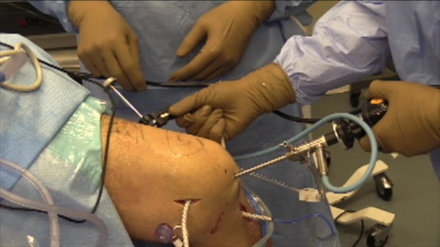 ACL MCL PCL Reconstruction