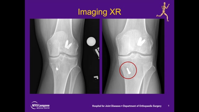 Tibial Tunnel Bone Grafting and Biological Augmentation