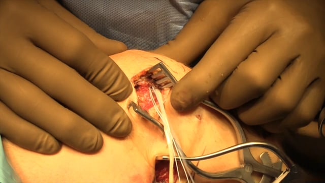 Isolated Medial Patellofemoral Ligament Reconstruction