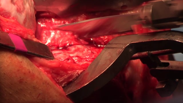 Osteochondral Proximal Tibial and Lateral Meniscal Allograft Transplantation