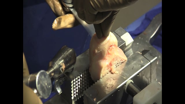 Osteochondral Allograft for a Full Thickness Articular Cartilage Defect of the Knee