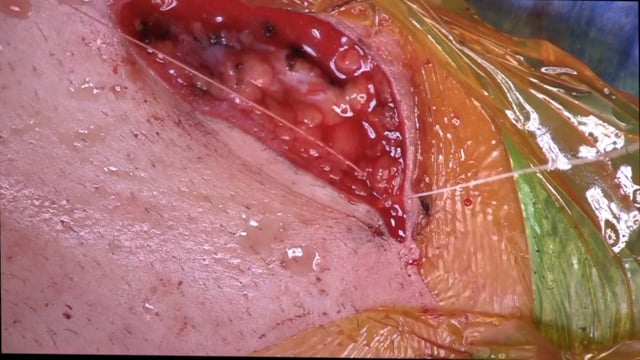 Sternoclavicular Joint Reconstruction