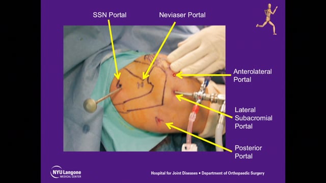 Arthroscopic Suprascapular Nerve Release