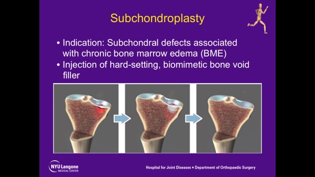 Distal Femoral Osteotomy & Subchondroplasty