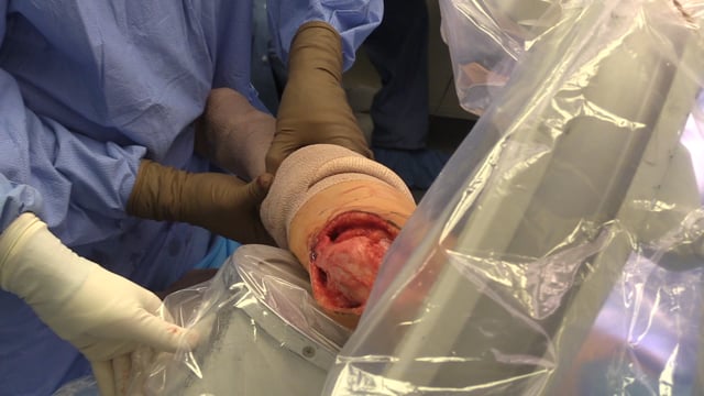Tibial Tubercle Osteotomy and DeNovo Cartilage Transplant for Patellar Chondral Defect