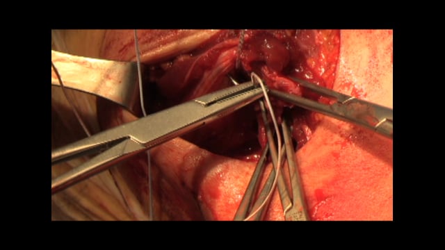 Pectoralis Major Repair