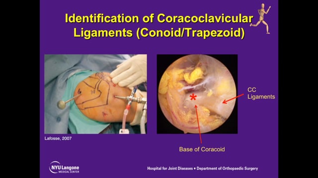 Arthroscopic Suprascapular Nerve Release