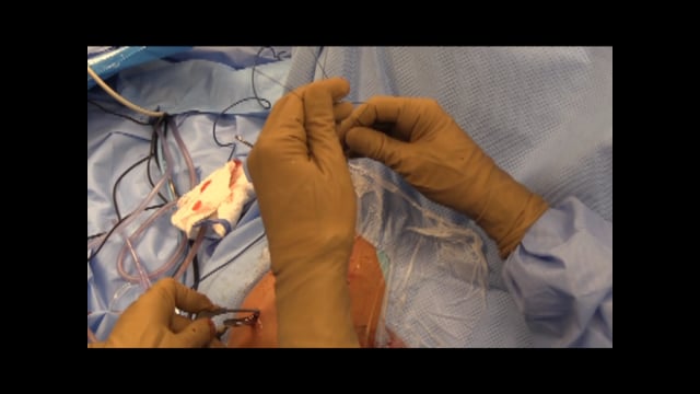 Arthroscopically Assisted AC-CC Joint Reconstruction of the Shoulder