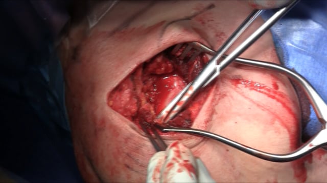 AC Joint Reconstruction using EndoButton and Dog Bone: Surgical Technique