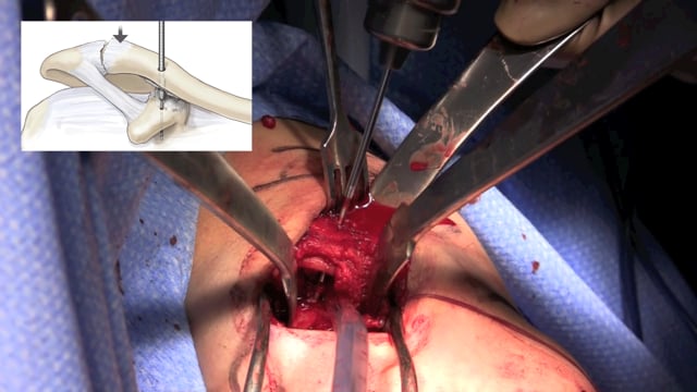Closed-Loop Double Endobutton Technique for Complete AC Joint Dislocation
