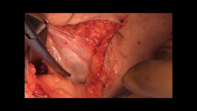 Popliteal Cyst Excision