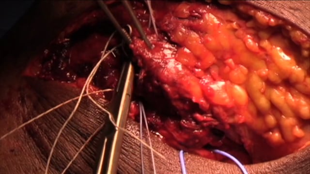 Open Posterolateral Corner Repair of the Knee