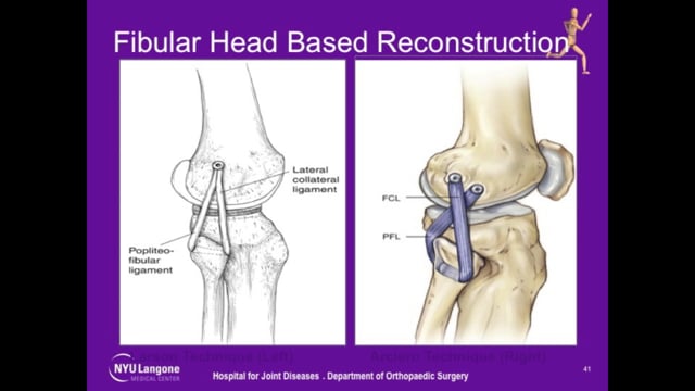 Surgical Management of Posterolateral Corner Injuries